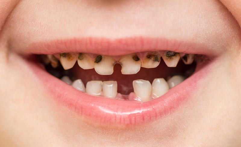 Почернели молочные зубы у ребенка: что делать, как лечить - - клиника Доктора Жукова